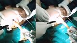 女子网购30厘米“催吐管” 反复多次塞进食道！