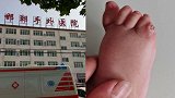 邯郸一幼儿小脚趾畸形 医生手术失误致截肢