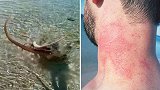 澳大利亚：男子在海边散步被章鱼袭击，脖子出现大片红肿