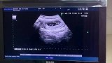 4个月胎儿的B超影像，小人型把心都萌化了！