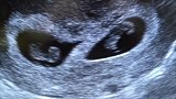 B超影像下双胞胎胚胎的模样，还能看到跳动的小心脏，萌化了！