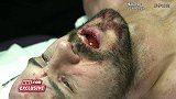 WWE-17年-2017毫不留情大赛：凯萨罗牙齿受伤接受缝针治疗-花絮