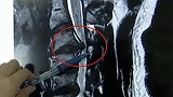 广东广州：26岁却有60岁的脊椎！小伙脊髓薄如纸片差点瘫痪