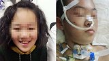 12岁女童疑遭继母虐待致脑梗死 全身多处软组织损伤