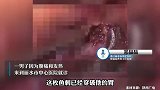 警惕！男子吃饭太快，发现几天前鱼刺穿破胃扎进肝脏