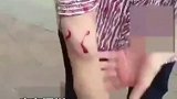 高空抛物太吓人 老人的手被砸骨折 高空抛物