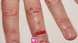 伤口愈合过程