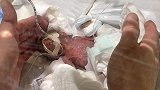 “世界最小的男婴”出院 出生时仅268克
