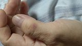 广东广州：一度高烧40度险丧命，医生在他手上发现可疑伤口