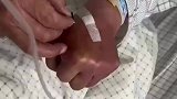 护士扎针没成功大爷自己上手