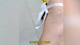 女子脚被钉子扎伤打针输液不见好，医生竟用蚂蟥吸锈毒：效果还挺好