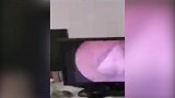 女子耳部不适就医 竟发现蜘蛛在耳朵里结网安家