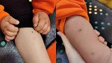 福州一幼儿园7名幼儿被针扎 家长：孩子已有心里阴影怕上学