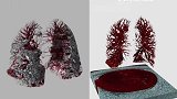 北大医学视觉技术新突破：彩色3D影像直观呈现肺炎病变