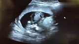 怀孕14周医院产检一切正常,一分钟开始可以清晰看出是个男宝！