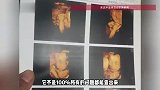 试管婴儿出生右脚缺4个脚趾，医院回应：超声检查有局限性