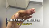 女子拔手指倒刺致骨髓炎：目前需进行刮骨手术，处理不当可能截肢