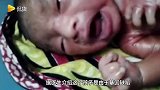 塑料套在身上？俄罗斯出生2个月婴儿全身皮肤通红干涩紧绷痛苦不堪超心疼！