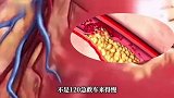 女性心梗就医比男性晚46分钟！不是120来得慢，而是症状不按“标准剧本”来