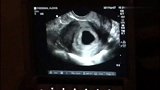 6周零一天的胎儿超声波，当初用了这三种试纸最终确定怀孕了
