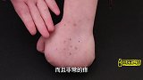 手上长了小水泡不能挠！越挠越痒，教你一招，快速止痒比牙膏好用