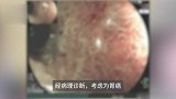因祸得福！男子误吞枣核就医取出，意外查出胃癌果断切除：生存率超95%