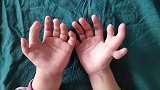 3岁女童双手长14个手指 医生：有家族病史