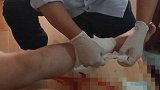 女子上厕所马桶爆裂 腿部受伤缝20多针