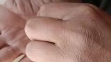 男子干活手受伤，用针线给自己缝伤口
