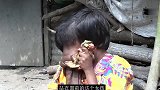 非洲女孩脸上得怪病，五官全部消失被肉吞噬，出门还得靠人扶才行