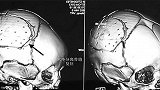 父亲玩“举高高” 3岁女儿被风扇削成颅骨粉碎性骨折