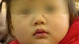 贵州贵阳：2岁女儿被老师指甲戳伤 家长：半年内第6次受伤
