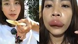 福建女子吃蜂巢被蛰成香肠嘴 当事人：喝水都漏