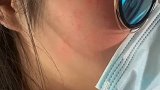福建一女子脸上得脚气长红痘 一翻视频自己秒懂