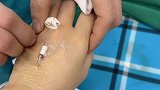 女子晒自己手术成功拔滞留针，隔着屏幕感觉到疼