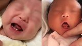 吉林一女婴出生3天就长2颗牙 妈妈忍痛喂奶被咬哭