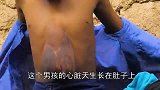 男孩的心脏天生长在肚皮上