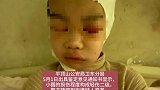 老师体罚学生致皮骨分离被拘：伤人至此，师德何在？