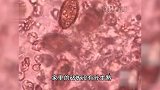 吓人！女子体内大量瓜子状活虫：自己从来不吃鱼生，家人爱吃