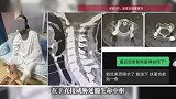 “能活着到医院就是个奇迹”，60岁老人因意外头颈分离，紧急抢救