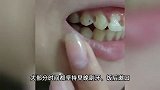 女子戴5年牙套摘掉后吓一跳，牙齿出现破洞：足足有8颗牙都坏了