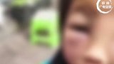 云南镇雄8岁小女孩被怀孕继母虐待后续：后妈被警方监视居住，当地妇联已关注!