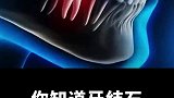 你知道牙结石是怎么形成的吗？