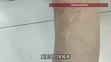 女子手术11年后发现螺钉遗留体内，医院承认医生个人失误，当地卫健局回应