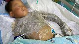 男孩摸了下“花蘑菇”整个手变黑差点没命 夏天千万当心它