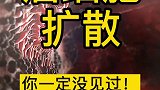 很多人没见过的癌细胞扩散过程，场面震撼！第一部健康