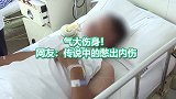 气大伤身！男子因工作调动被气出胃穿孔 网友：传说中的憋出内伤