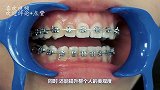 牙套是如何矫正牙齿的？3D动画演示全程，看完涨见识了