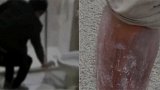 男子住酒店半夜脚趾突然一阵剧痛 整条腿肿得通红十分吓人