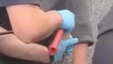 手被水泥粘住拔不出来，民警用锥子一点凿开
